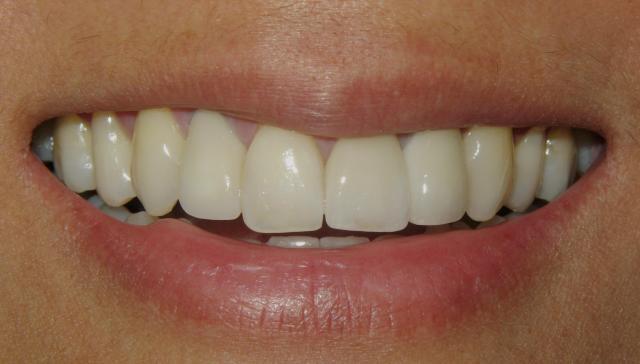 Bay View Dental patient after cosmetic dentistry