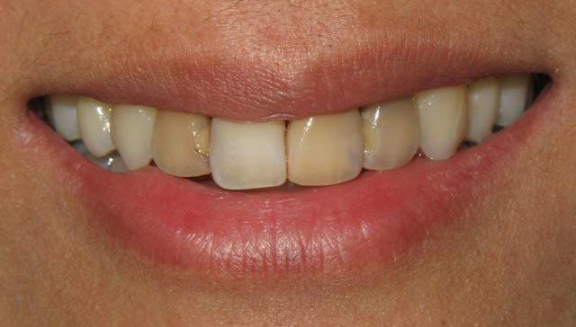Bay View Dental patient before cosmetic dentistry